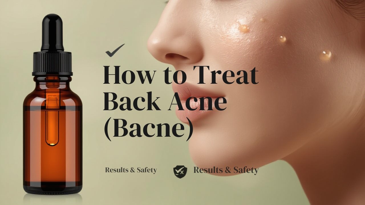 Hymey’s Anti Acne Serum – Effective treatment for back acne in Pakistan